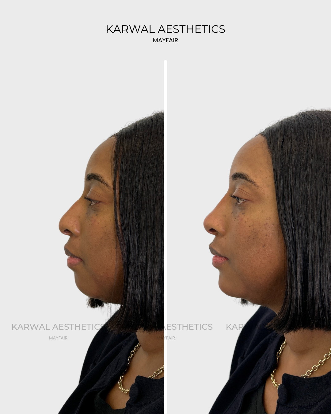 Non surgical rhinoplasty Karwal Aesthetics result London