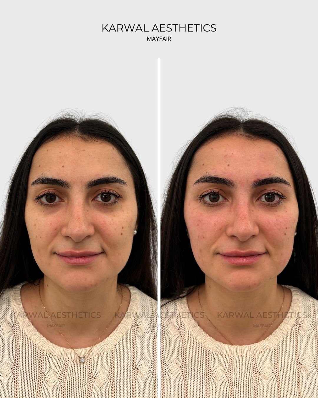 Tear Trough Filler Before and After Mayfair
