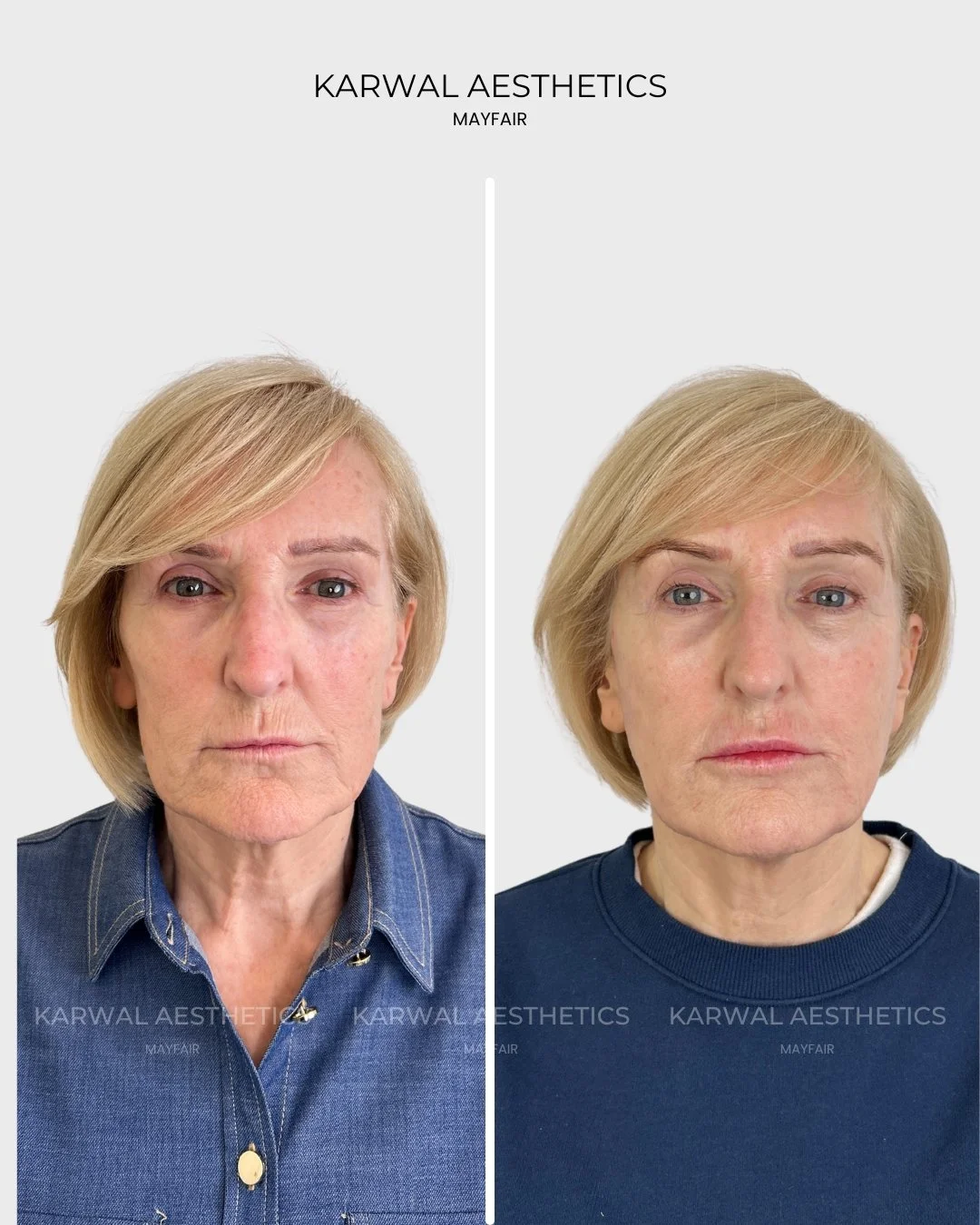 Endolift before and after - Karwal Aesthetics London