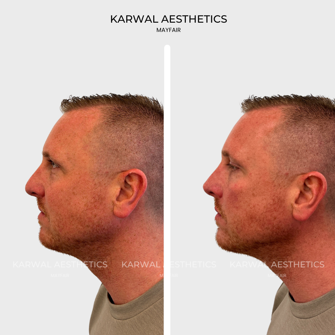 profile balancing male result