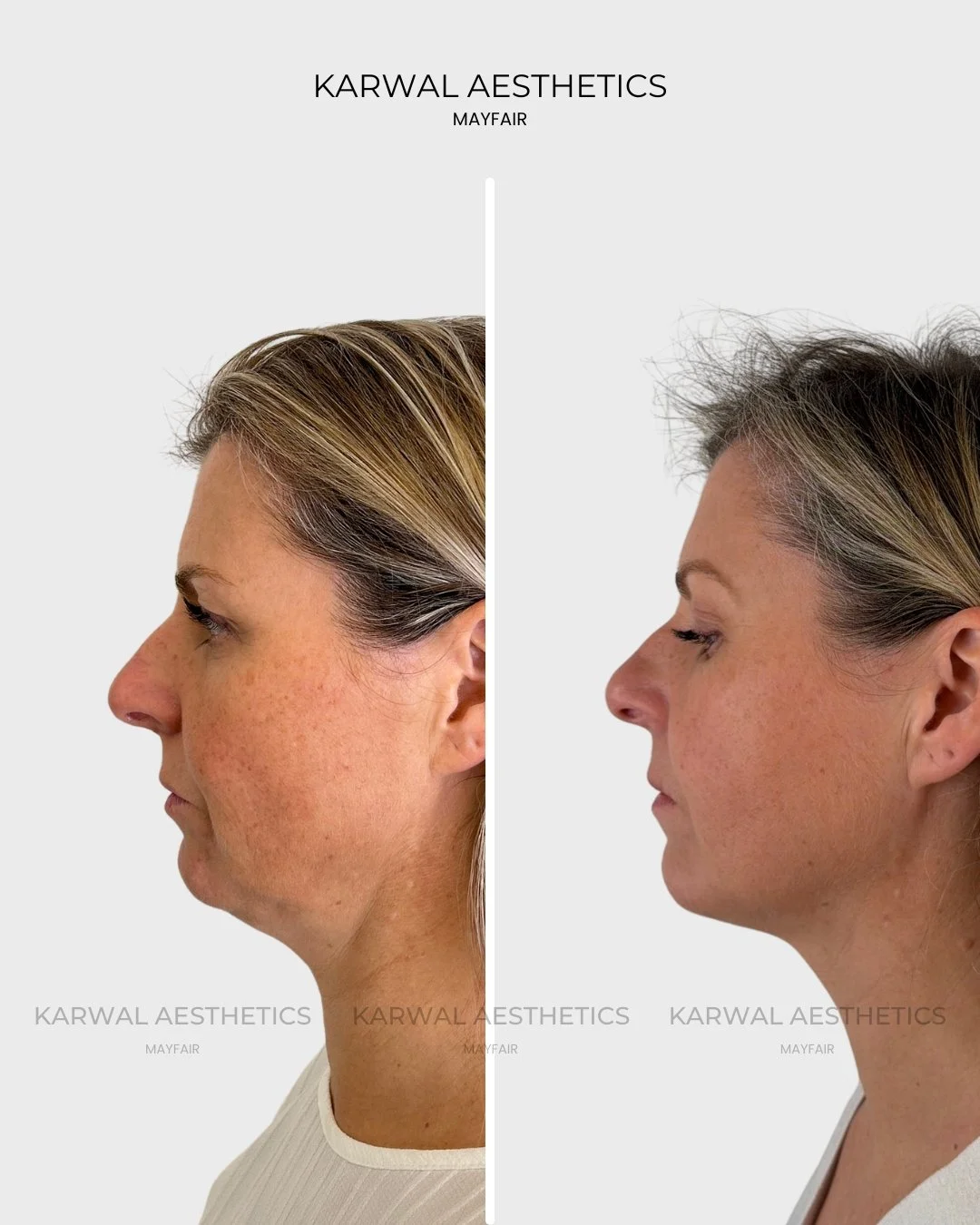 Endolift before and after - Karwal Aesthetics London