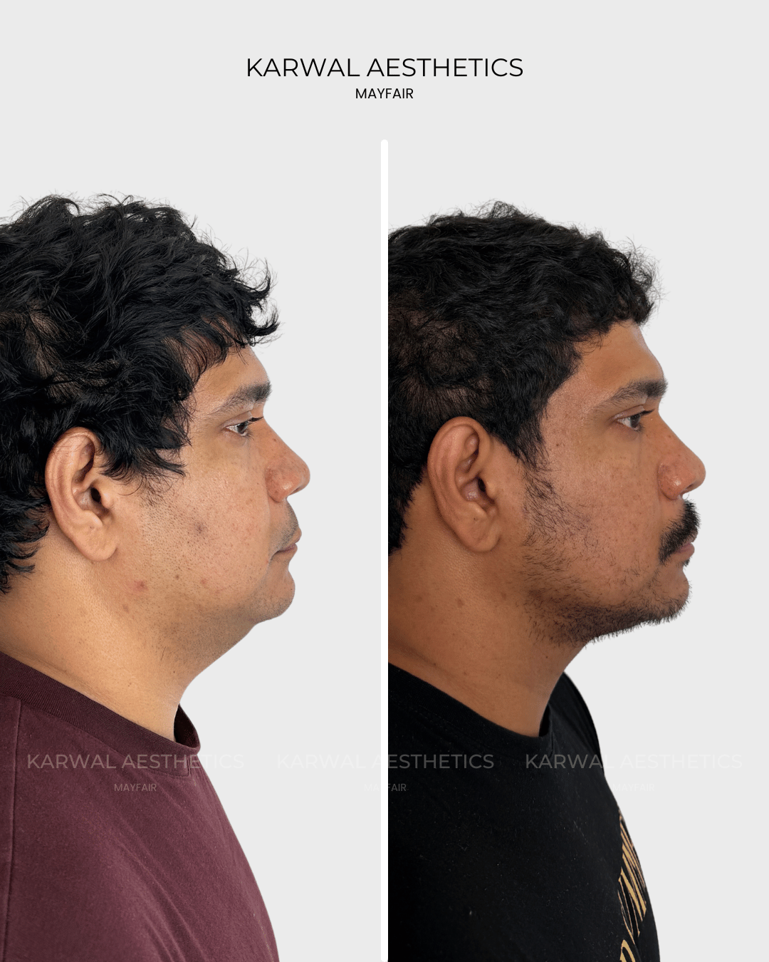 Endolift lower face and under chin before and after, Karwal Aesthetics London