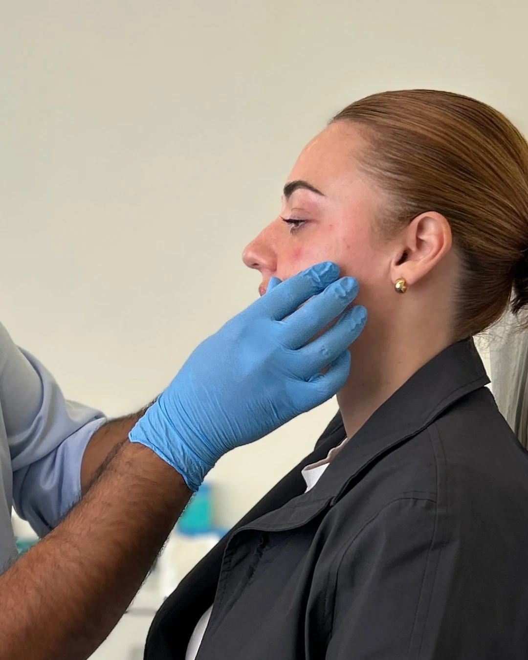 Cheek filler London.