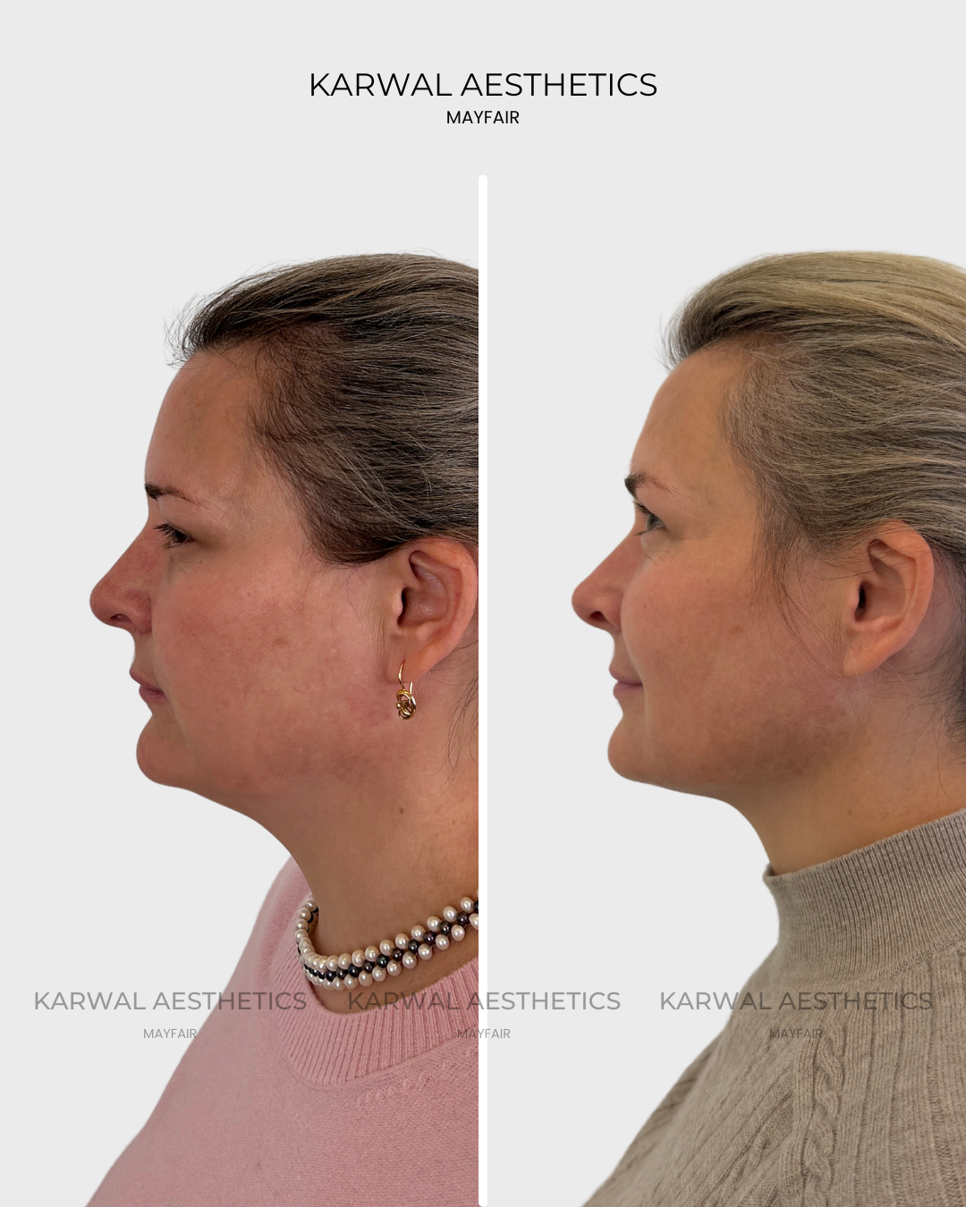 Endolift result by Dr Karwal London