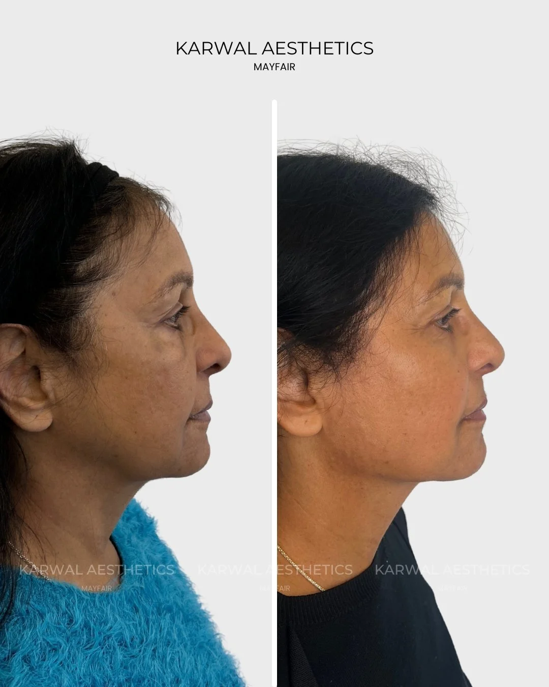 Endolift before and after - Karwal Aesthetics London