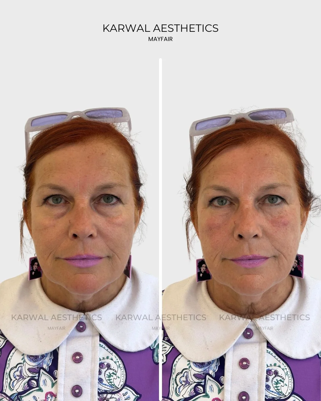 Tear Trough Filler Before and After | Karwal Aesthetics London