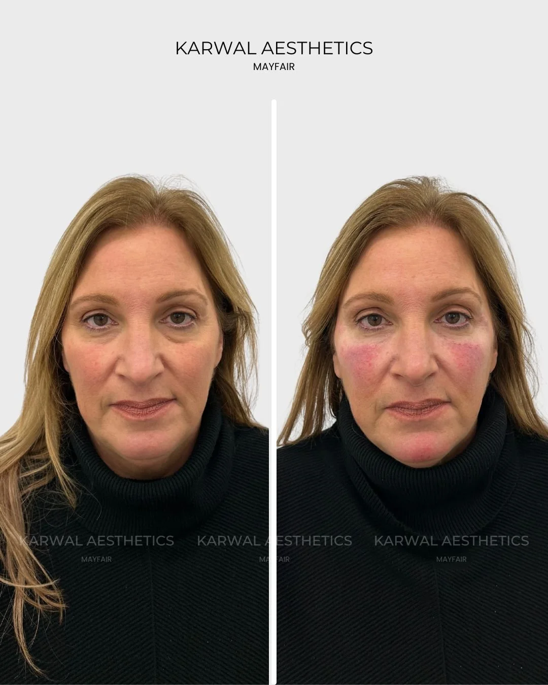 Under Eye Filler Before and After London