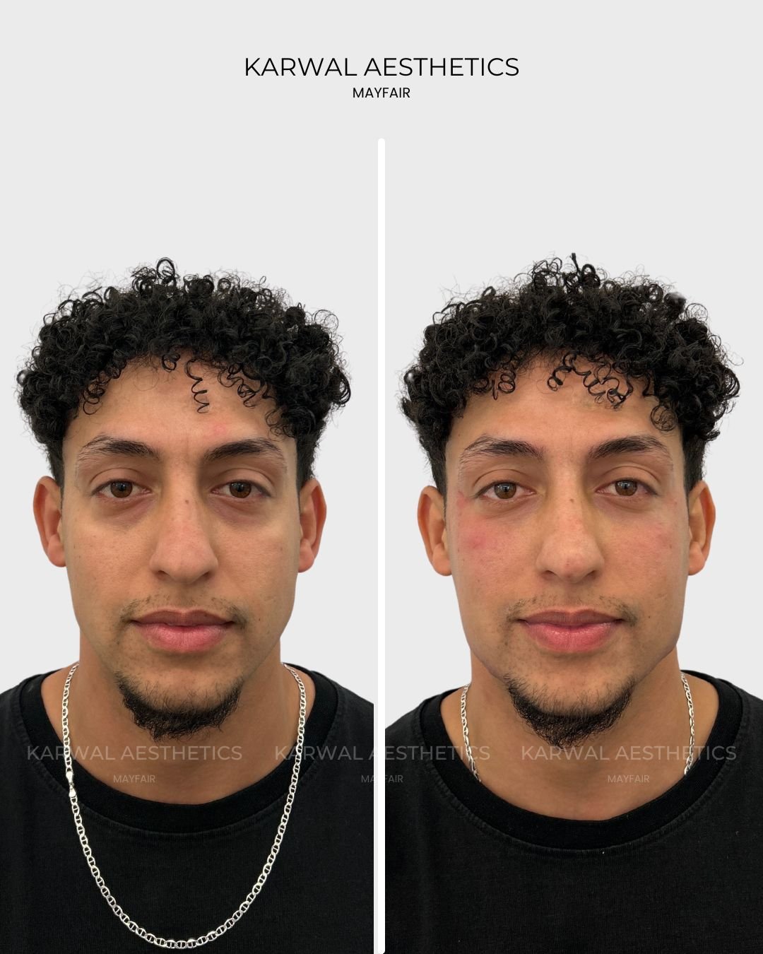 Tear Trough Filler Before and After | Karwal Aesthetics