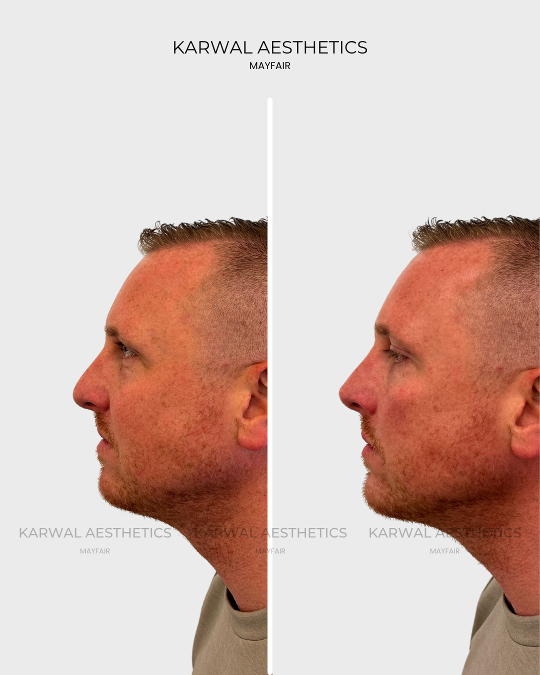 Non surgical rhinoplasty Karwal Aesthetics result London