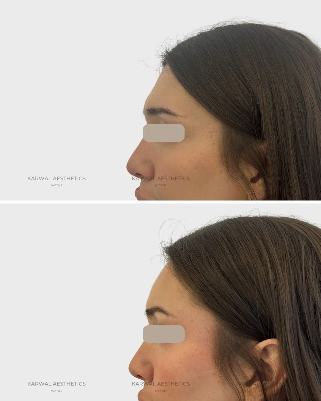 Forehead filler result - Karwal Aesthetics London