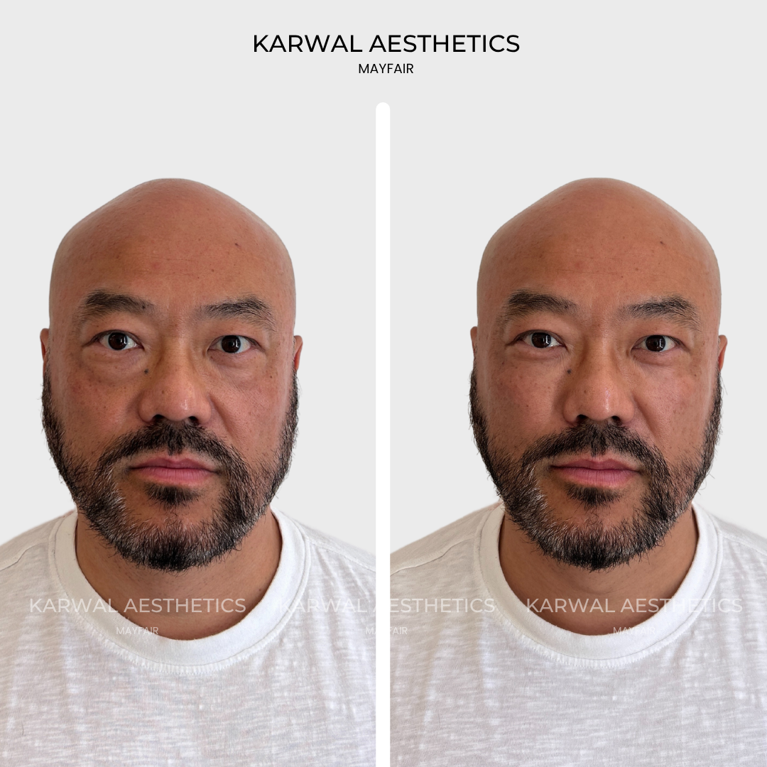 Tear trough filler and anterior cheek filler result, London.
