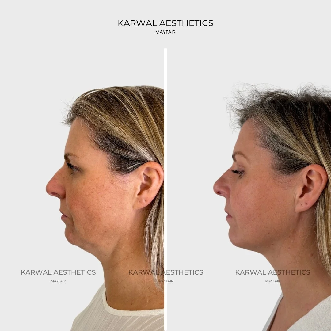 Endolift result, Karwal Aesthetics London