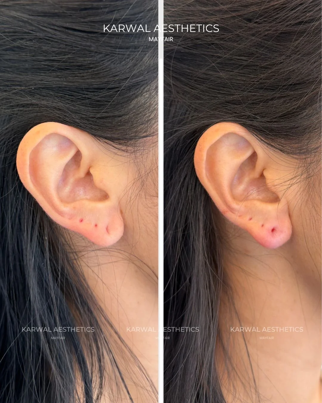 Ear lobe filler result London