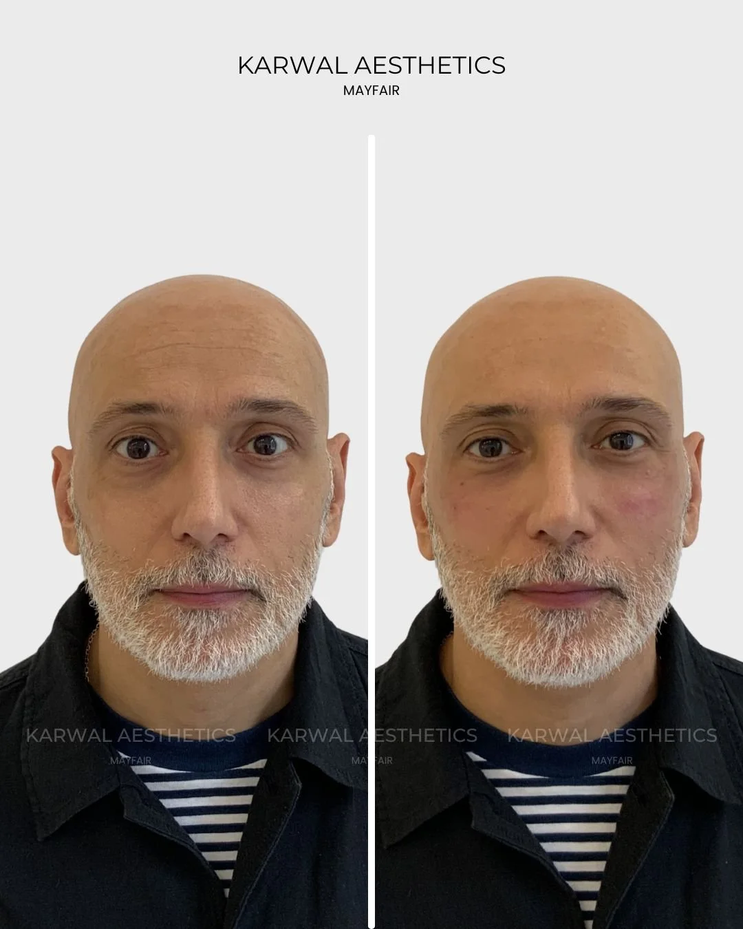 Tear Trough Filler Results London 