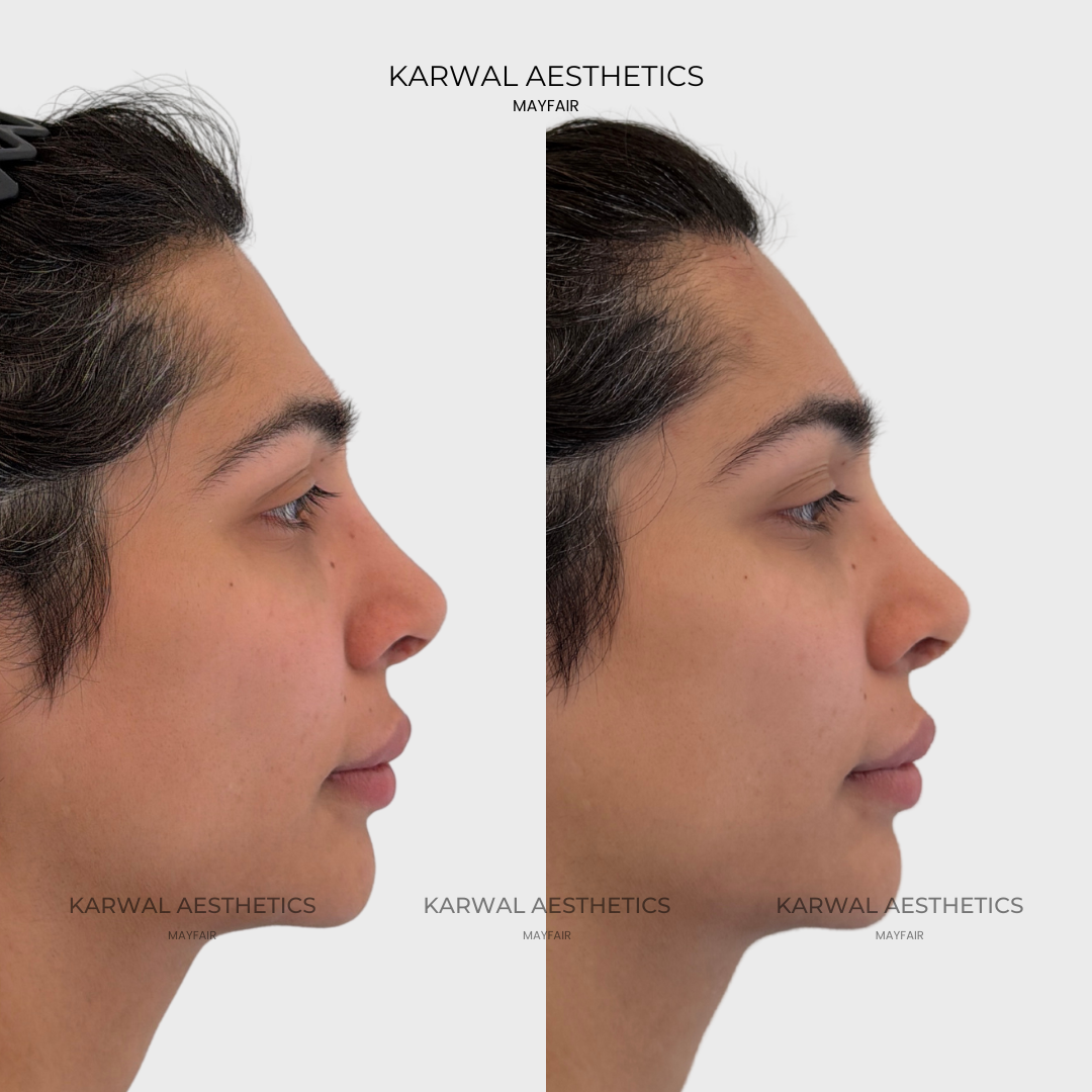 Forehead Filler Result - Karwal Aesthetics London