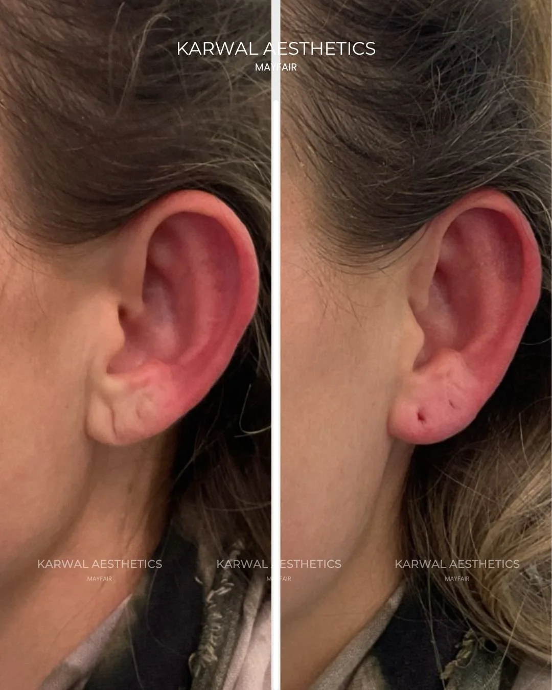 Ear lobe filler result London