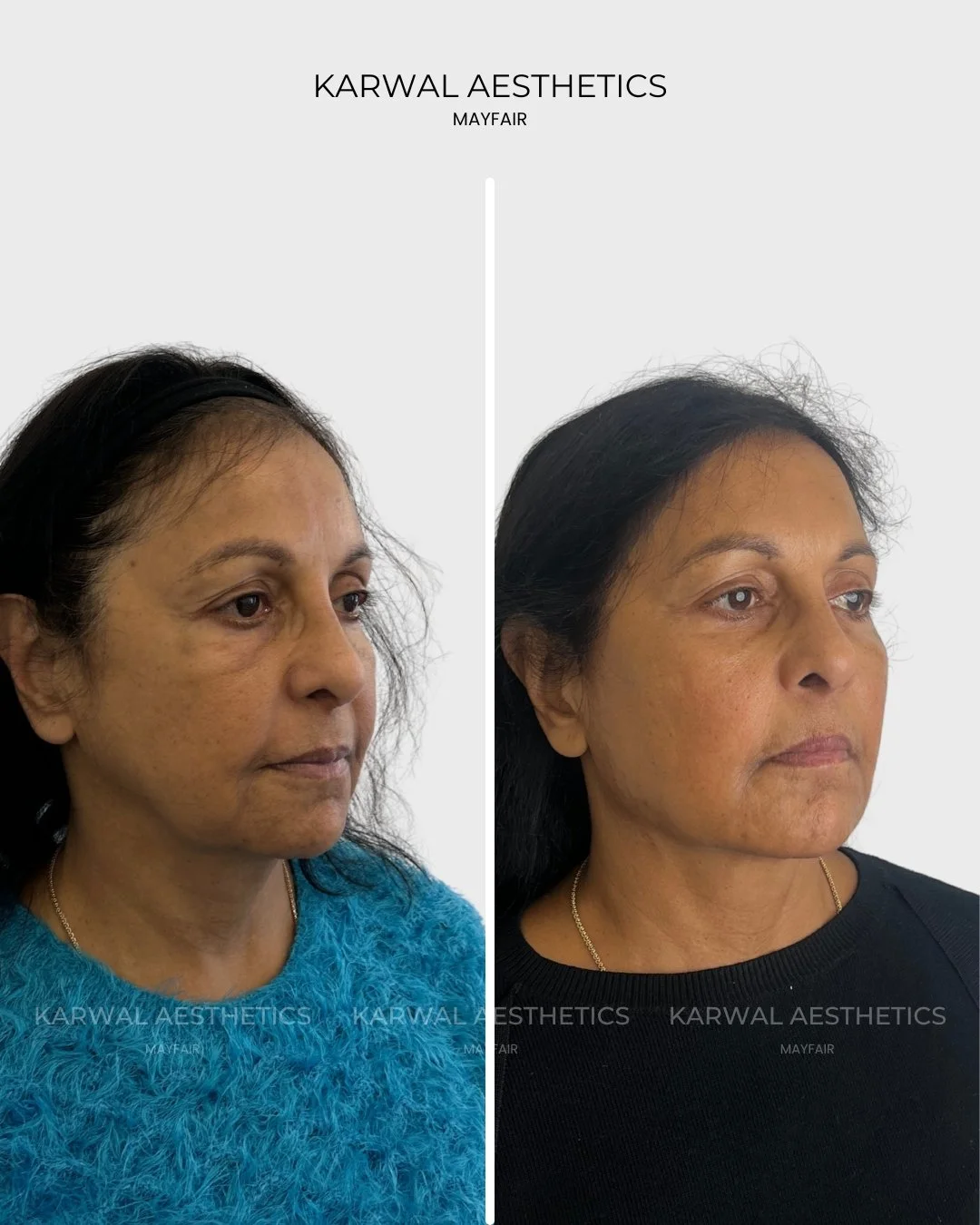 Endolift before and after - Karwal Aesthetics London