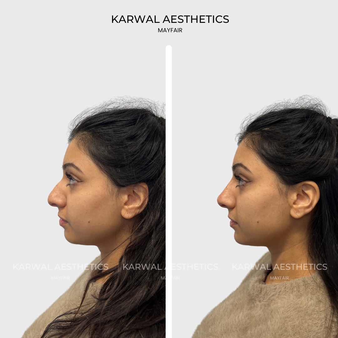 nose filler london