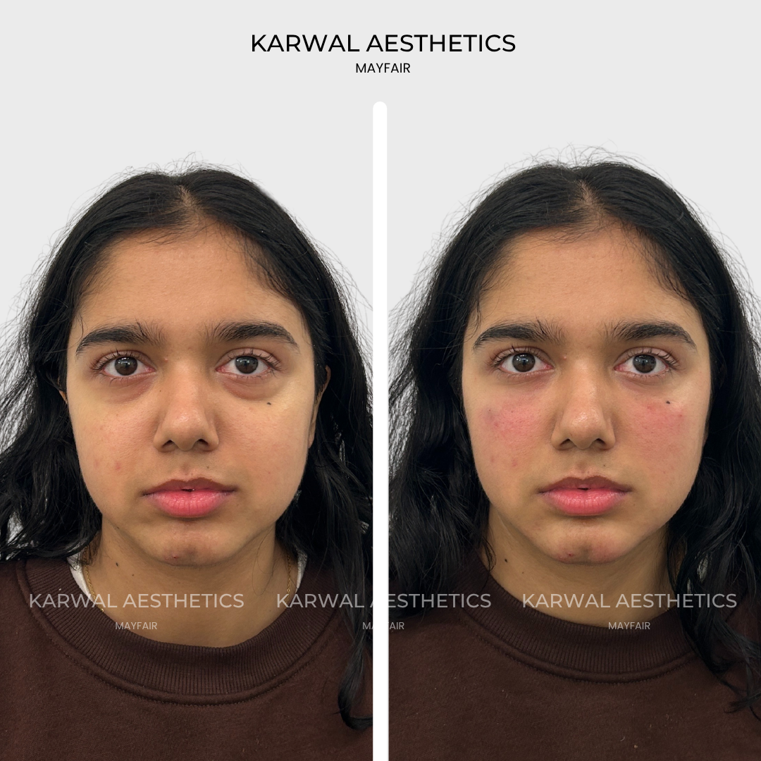 Tear trough filler, under eye filler result, before and after London.