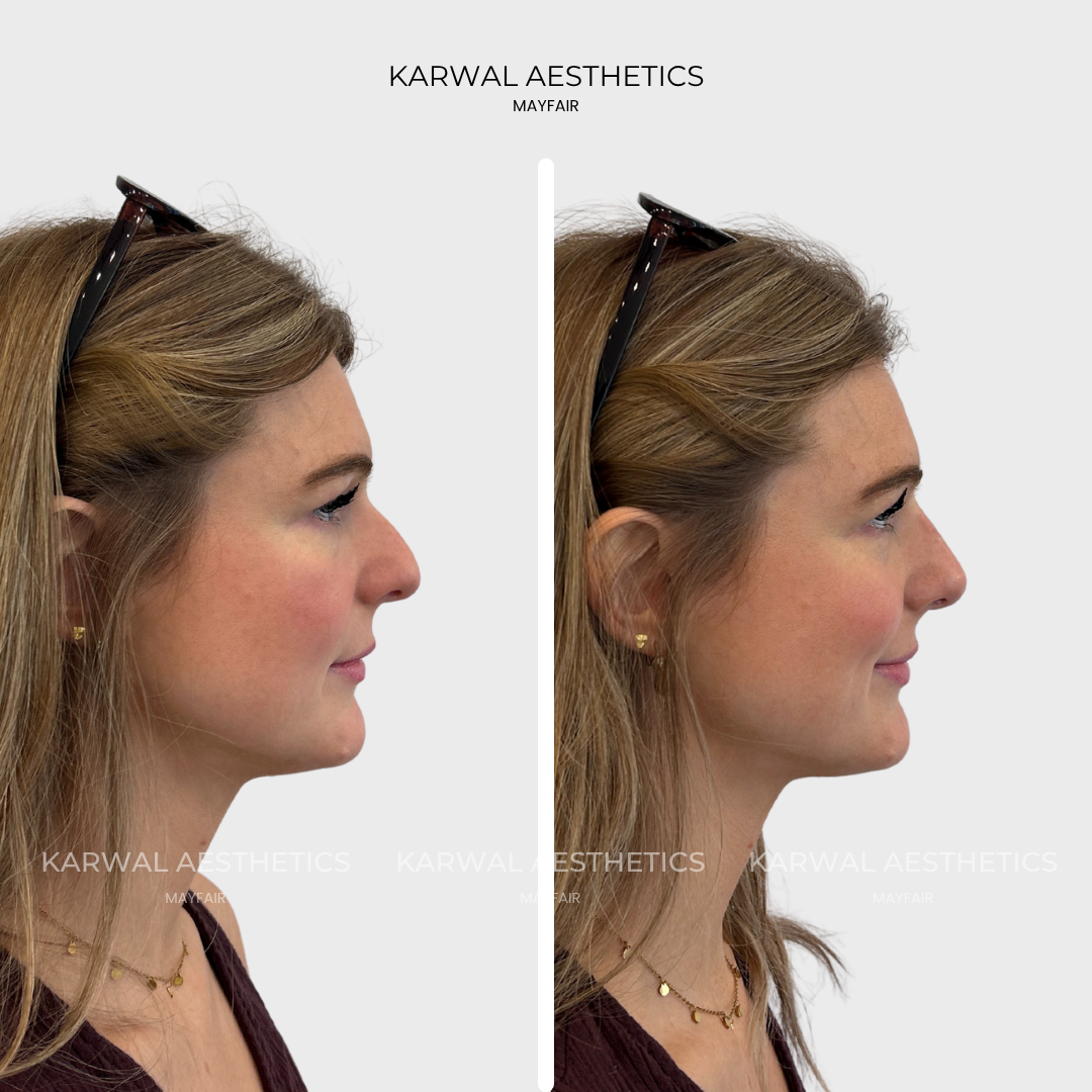 Nose filler result, London.