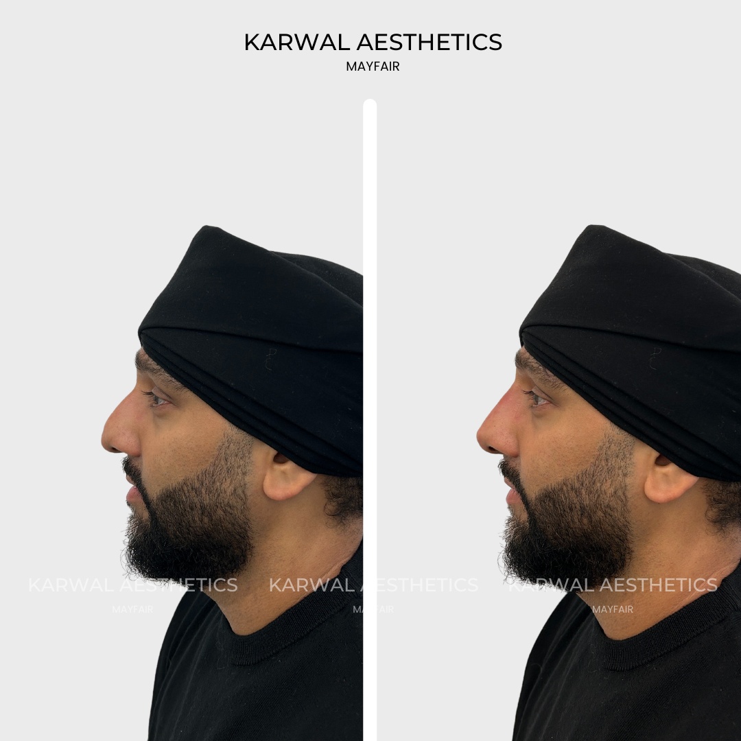 non surgical rhinoplasty london