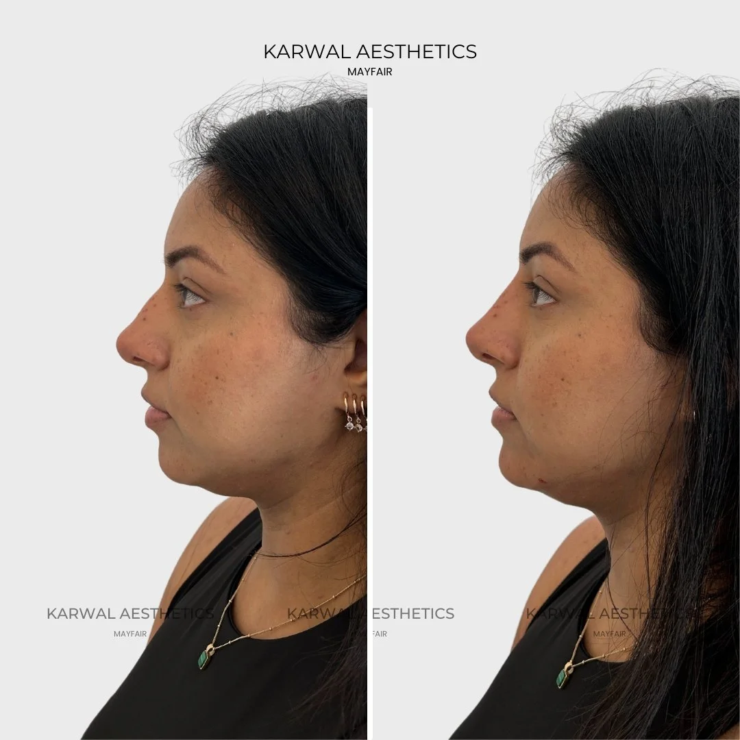 non surgical rhinoplasty and chin filler