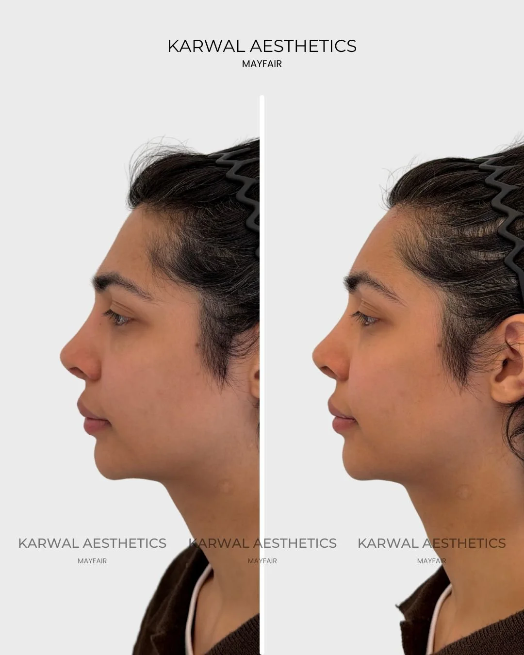 Forehead Filler Result - Karwal Aesthetics London