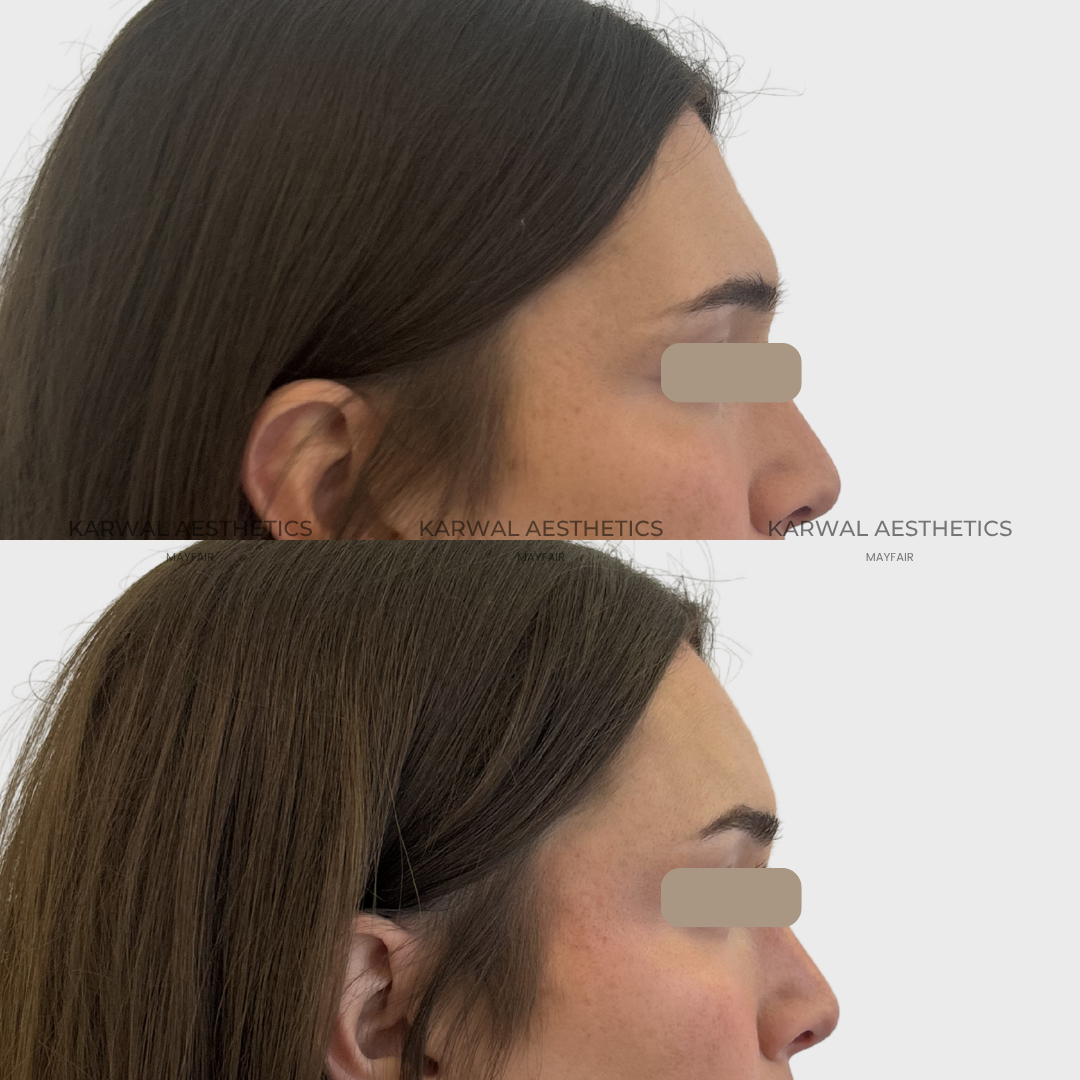 Forehead filler result - Karwal Aesthetics London