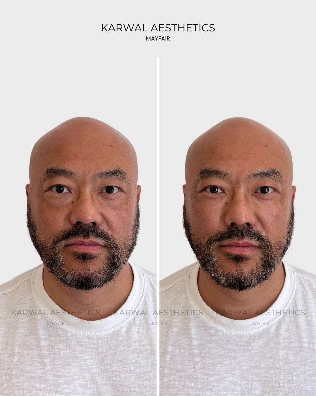 Tear trough filler before and after result, Karwal Aesthetics, London.