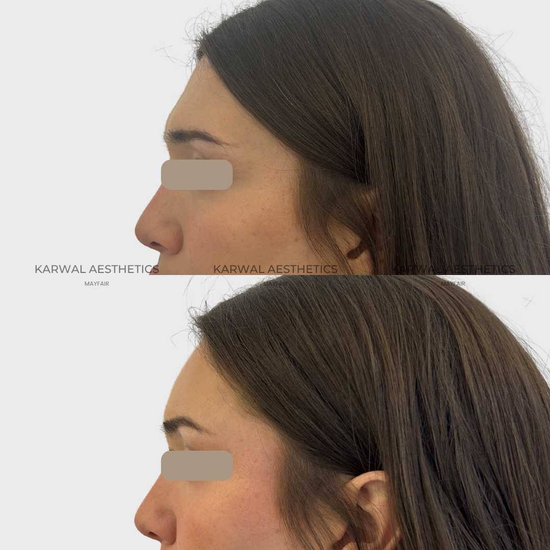 Forehead filler result - Karwal Aesthetics London