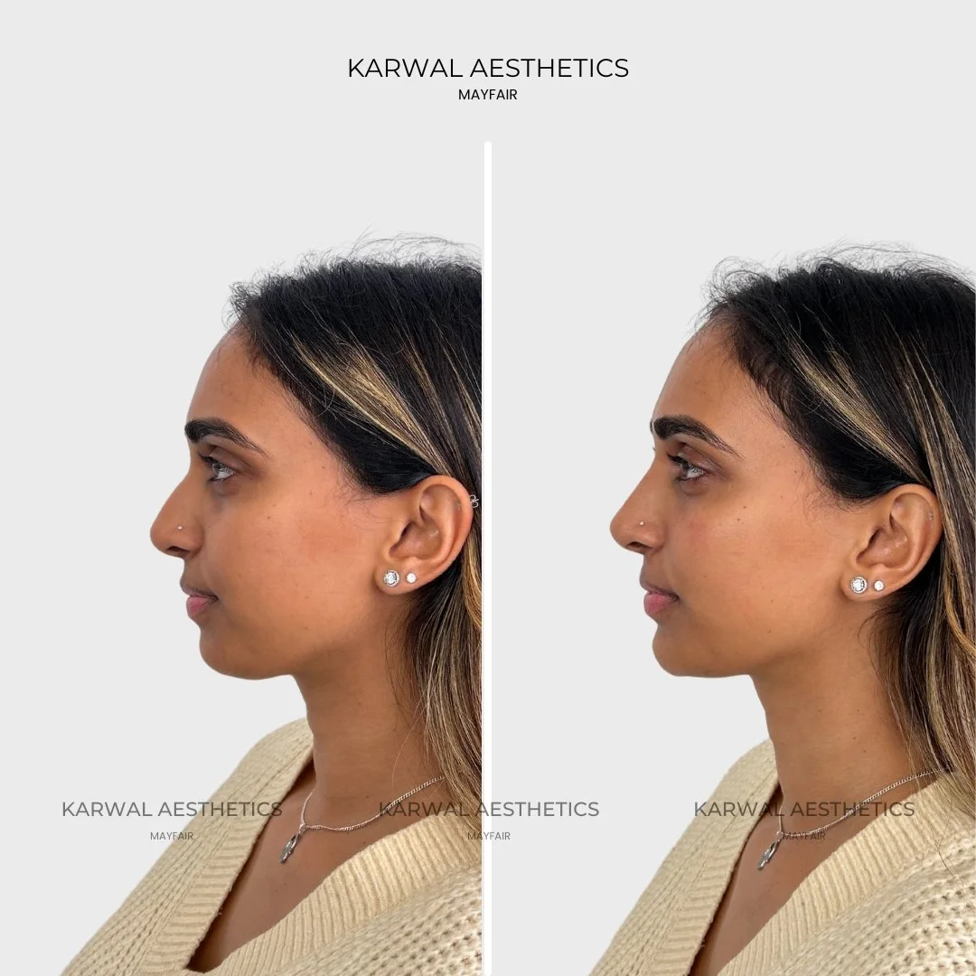 chin filler london