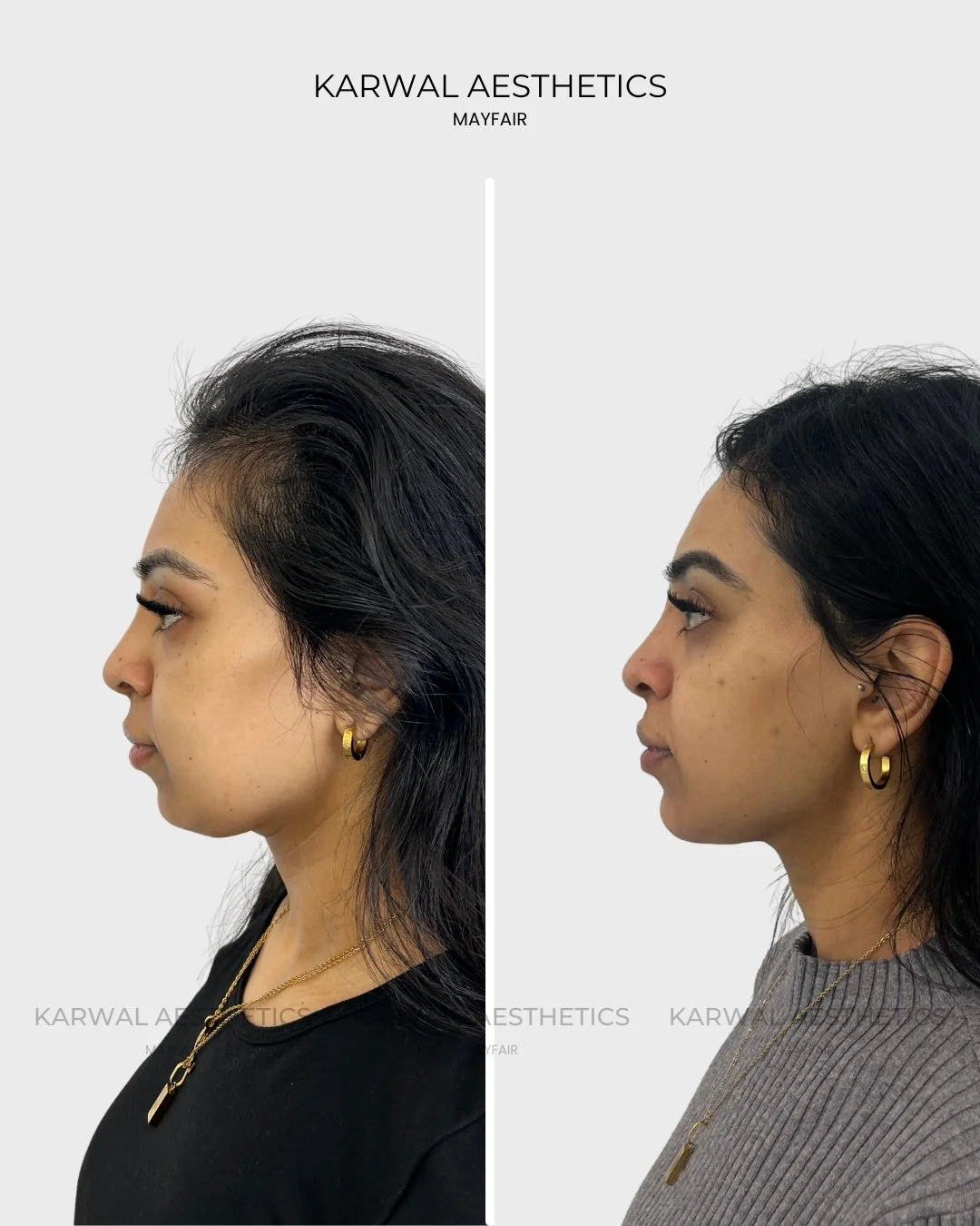 Endolift before and after - Karwal Aesthetics London