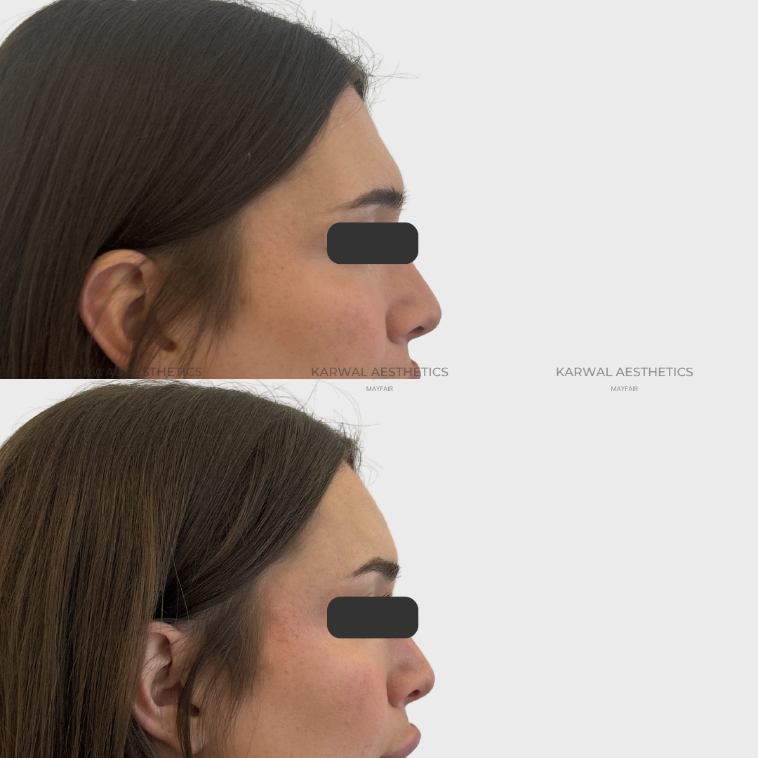 Before & after forehead filler at Karwal Aesthetics London showing a straighter nose profile after dermal filler.