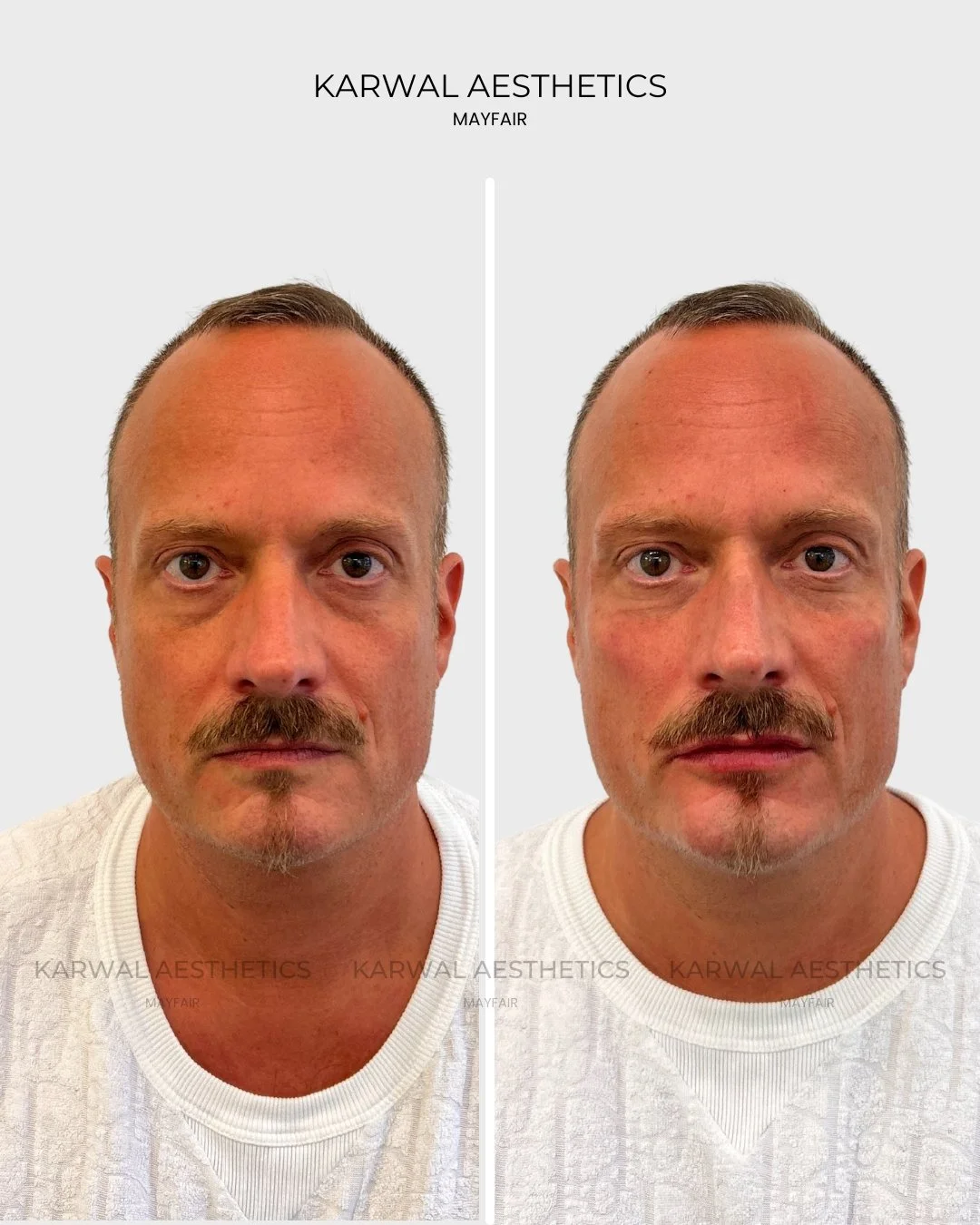 Tear Trough Filler Before and After | Karwal Aesthetics London