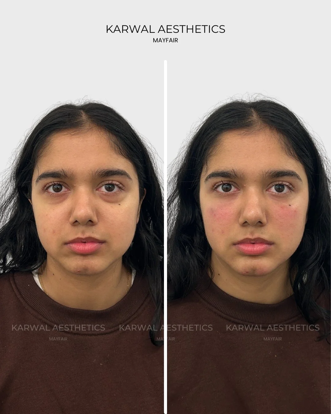 Tear Trough Filler Before and After | Karwal Aesthetics London