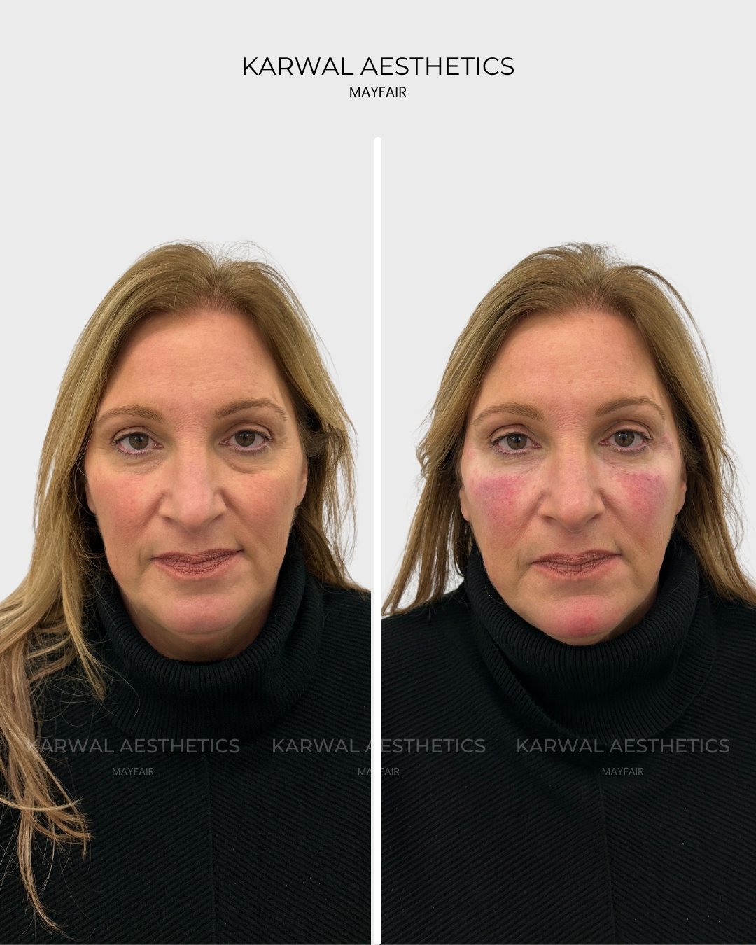 Tear Trough Filler Before and After | Karwal Aesthetics London