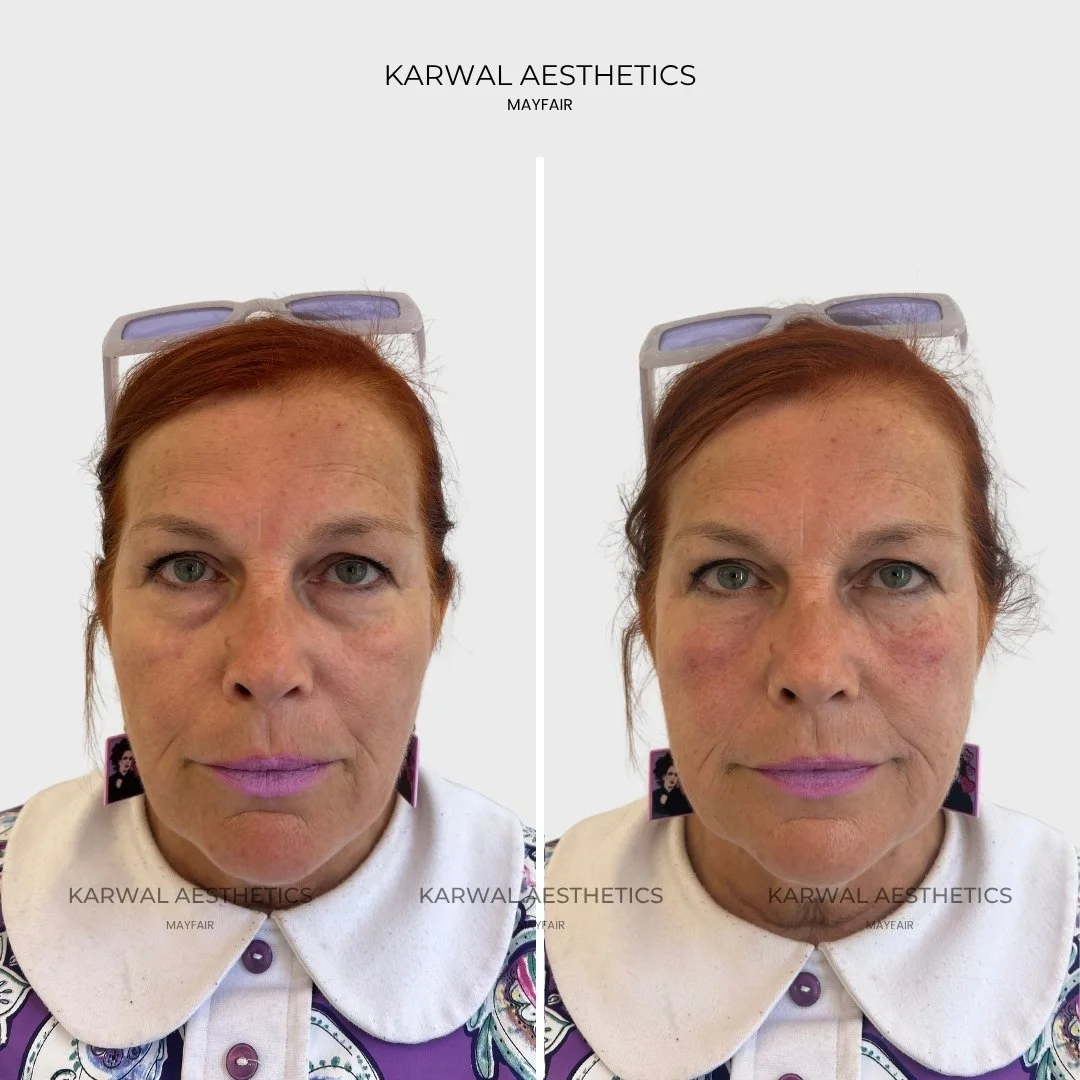 Tear trough filler -  under eye filler Karwal Aesthetics London