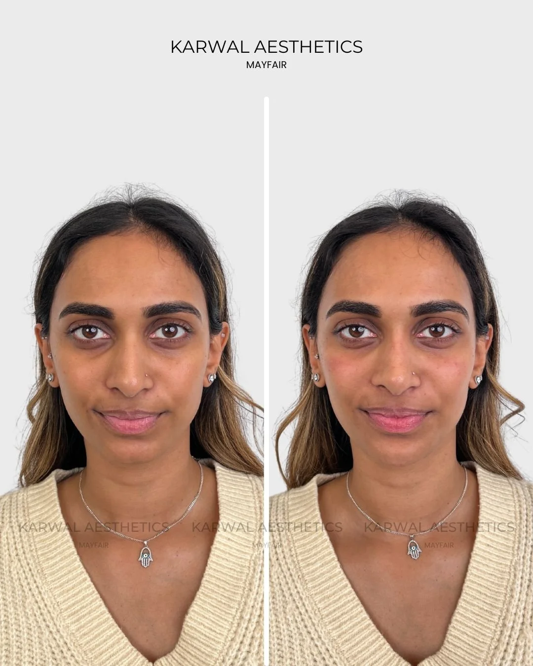 Under Eye Filler Before and After Results London