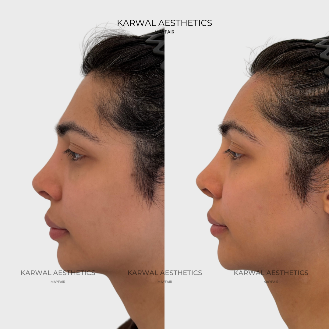 Forehead Filler Result - Karwal Aesthetics London