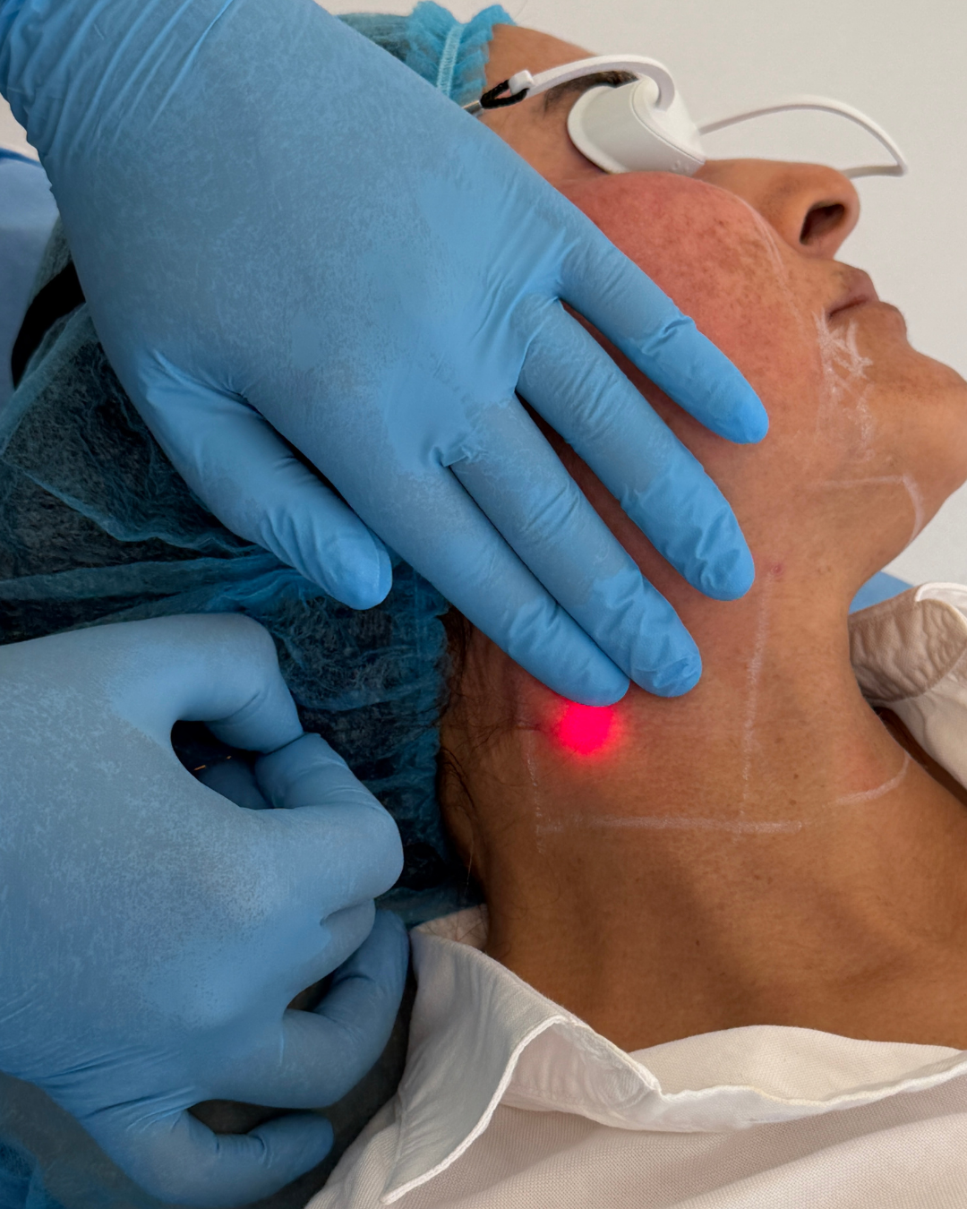 Endolift Karwal Aesthetics