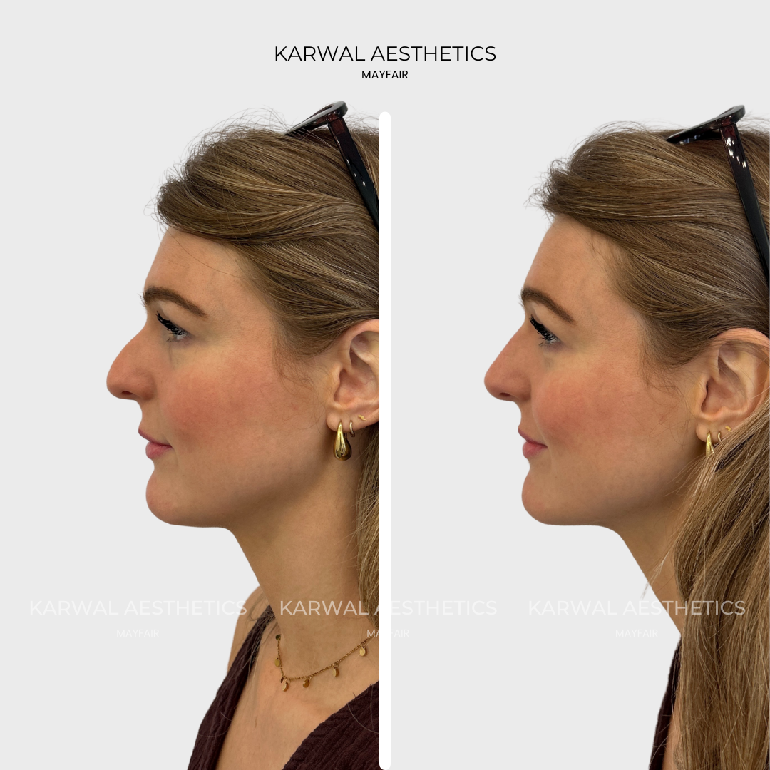 non surgical nose job, karwal aesthetics london