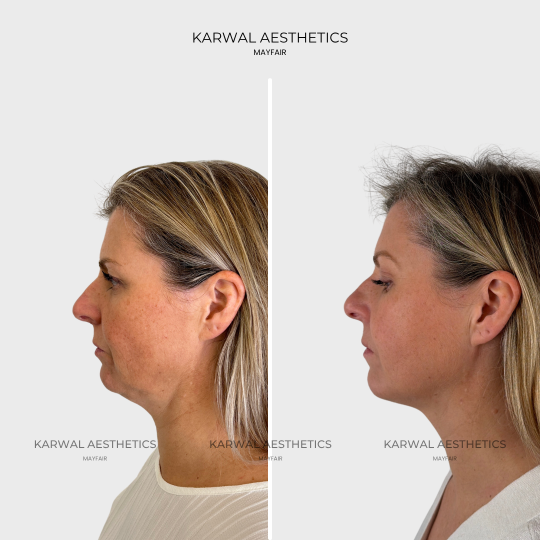 Endolift result before and after. Karwal Aesthetics London. 