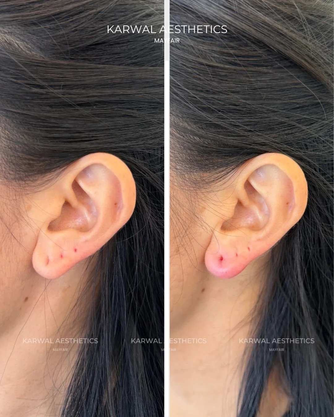 Ear lobe filler result London