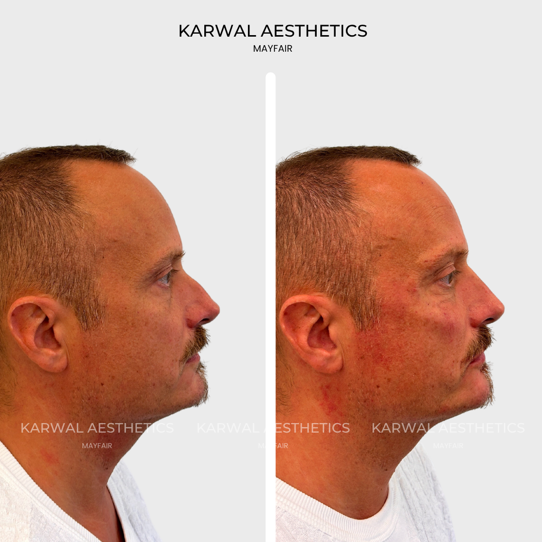 Nose filler result, London.