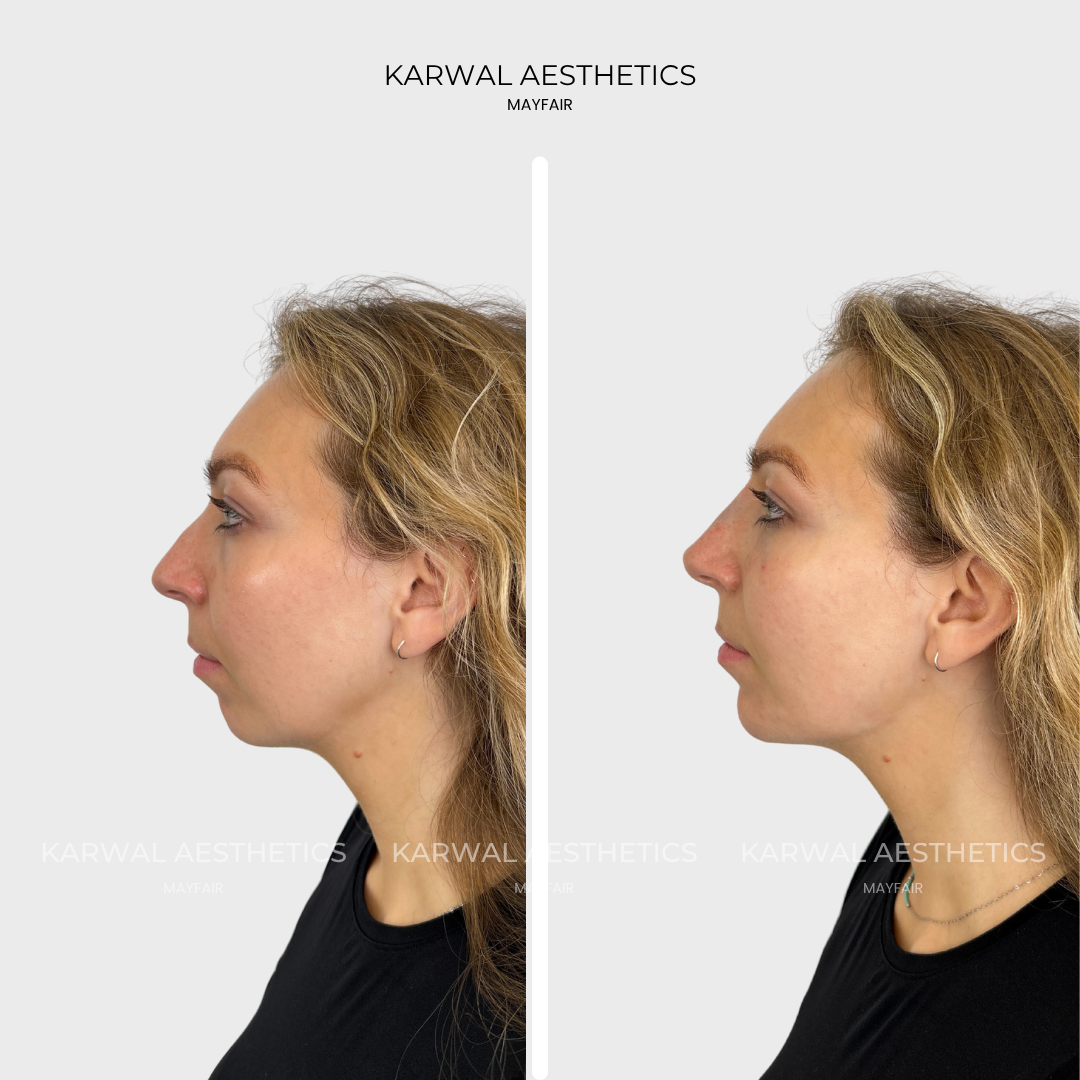 Profile balancing, nonsurgical rhinoplasty and chin filler, London.