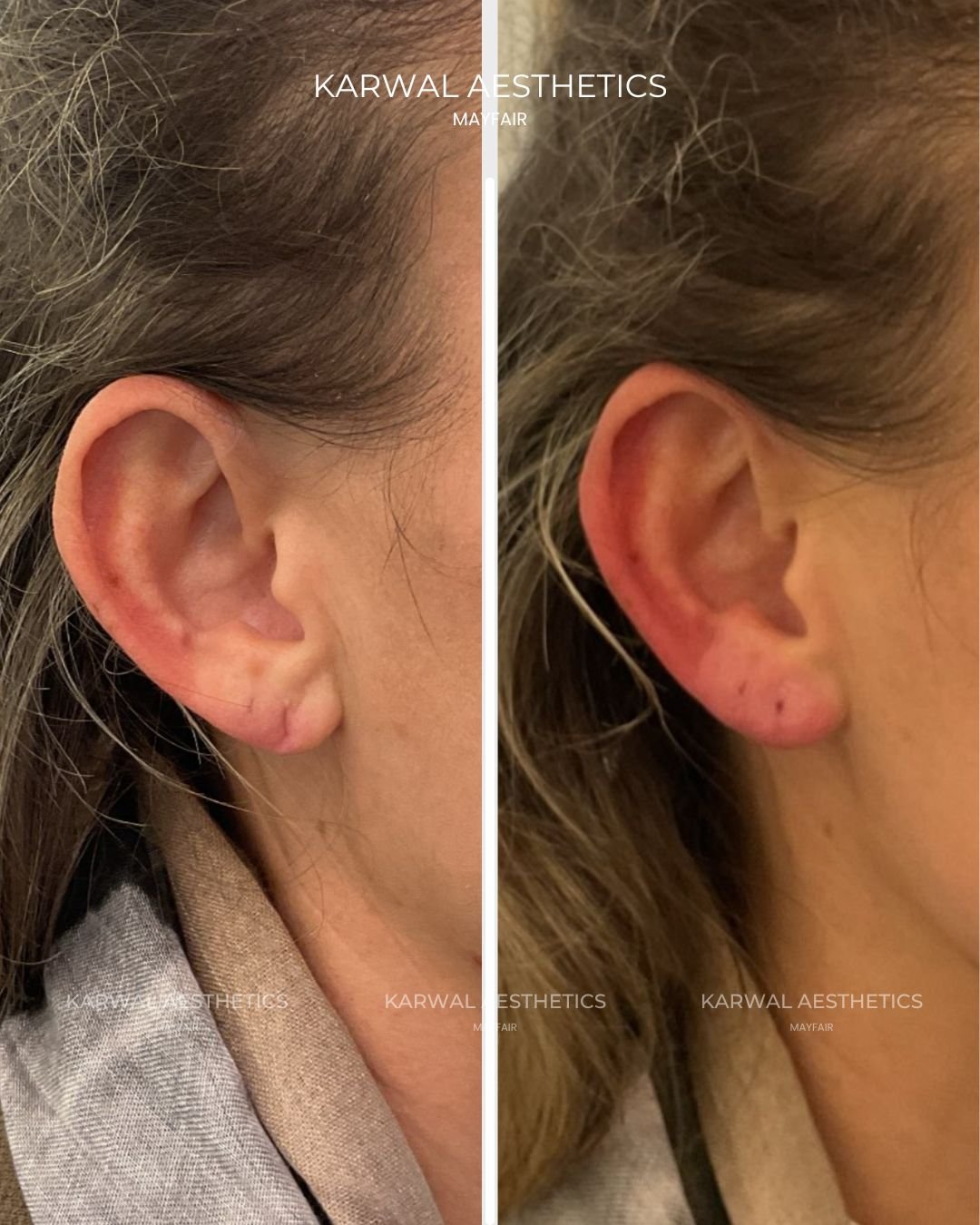 Ear lobe filler result London