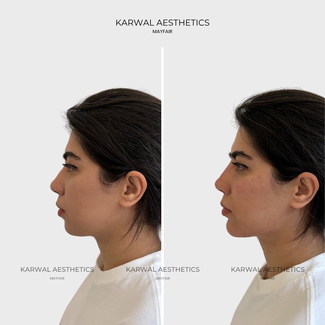 Profile balancing using dermal fillers at Karwal Aesthetics London