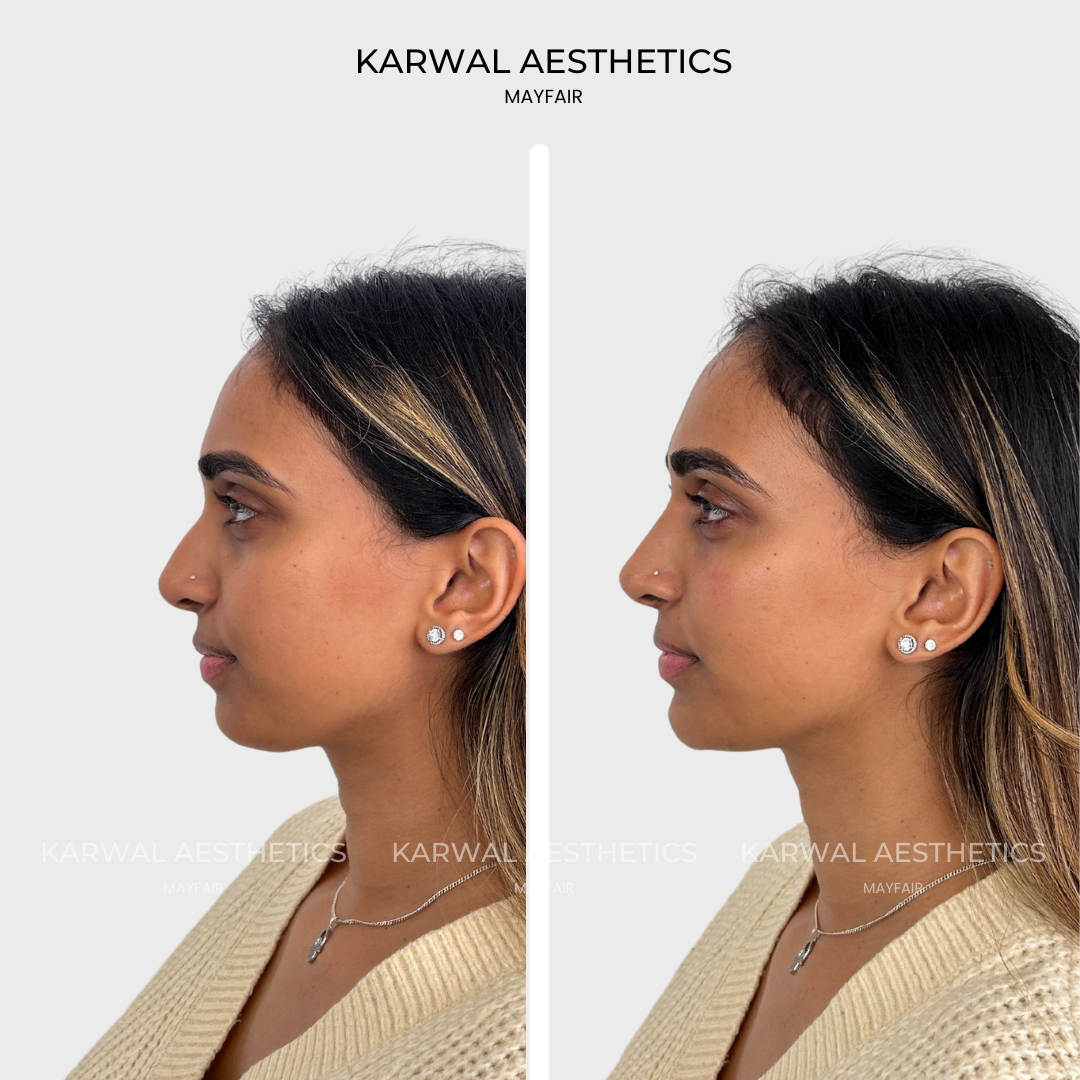 non surgical rhinoplasty.png