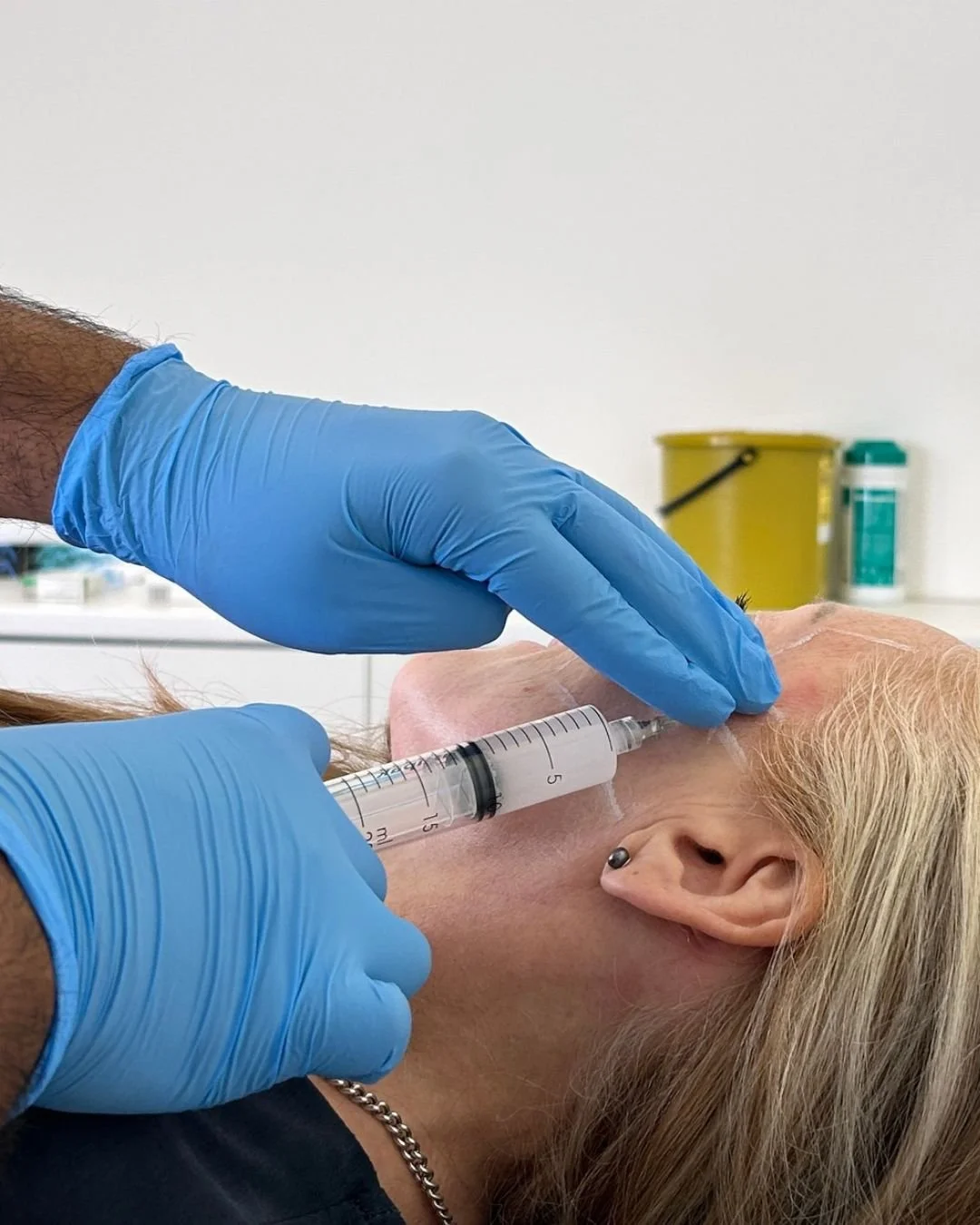 Sculptra collagen stimulating treatment at Karwal Aesthetics in Mayfair, London