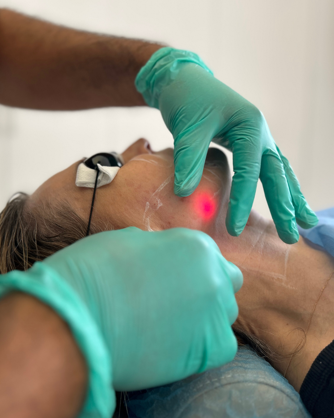 Endolift